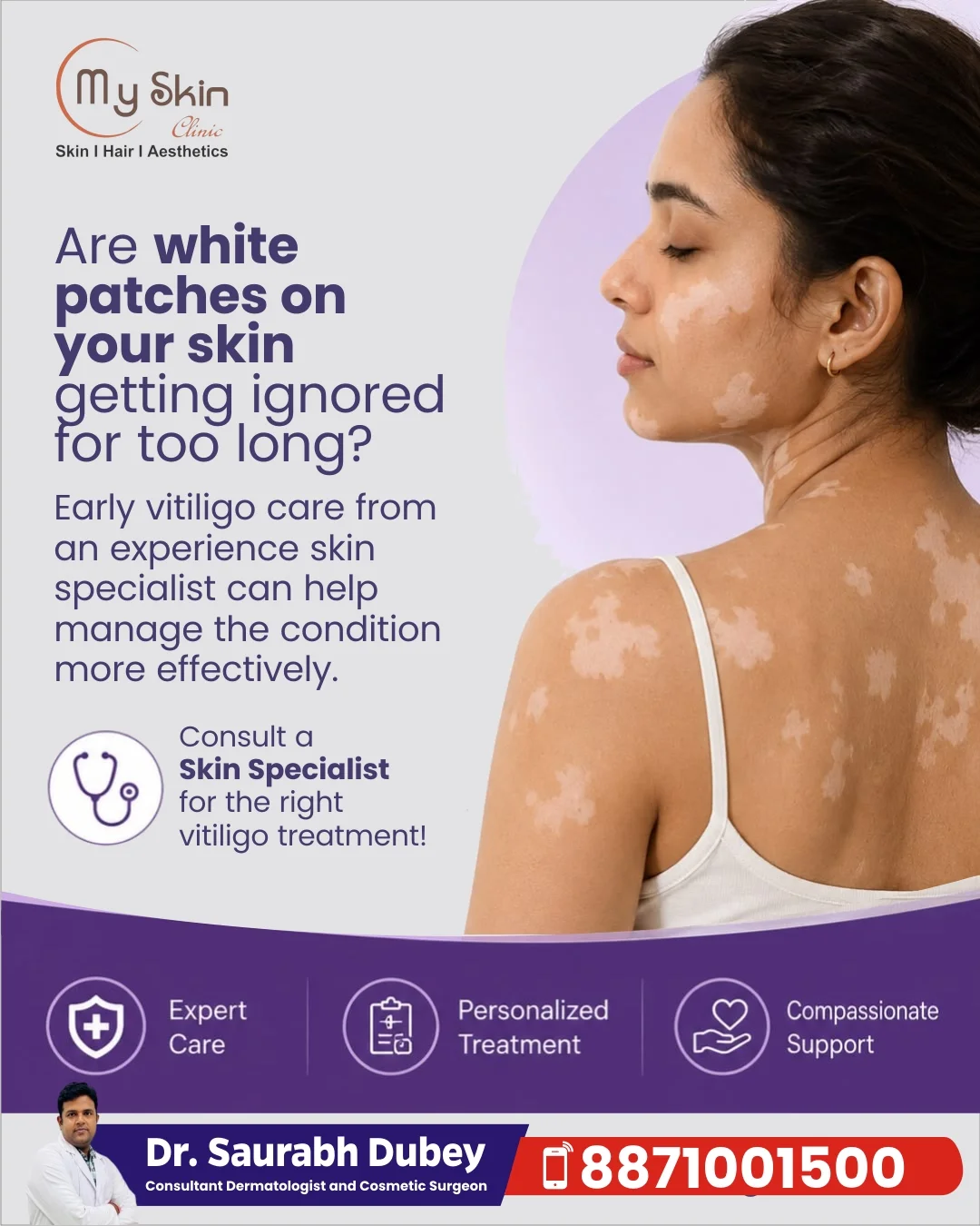 Vitiligo Treatment in Indore – Understanding White Patches and When to See a Skin Specialist